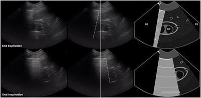 Abnormal Curtain Signs Identified With a Novel Lung Ultrasound Protocol in Six Dogs With Pneumothorax